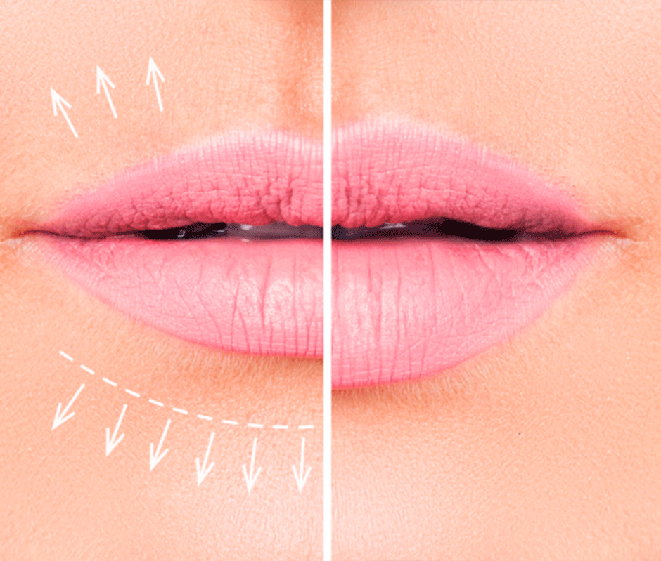 Увеличение и изменение формы губ